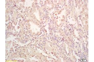 Formalin-fixed and paraffin embedded human gastric carcinoma labeled with Rabbit Anti FES Polyclonal Antibody, Unconjugated (ABIN714191) at 1:200 followed by conjugation to the secondary antibody and DAB staining (FES Antikörper  (AA 121-220))