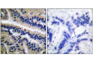 Immunohistochemical analysis of paraffin-embedded human lung carcinoma tissue, using Caspase 9 (cleaved-Asp353) antibody. (Caspase 9 Antikörper  (Cleaved-Asp353))
