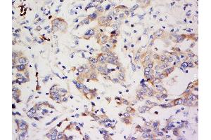 Formalin-fixed and paraffin embedded human breast carcinoma labeled with Anti-ZNF703 Polyclonal Antibody, Unconjugated  at 1:500 followed by conjugation to the secondary antibody and DAB staining. (ZNF703 Antikörper  (AA 221-320))