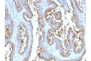 Formalin-fixed, paraffin-embedded human Prostate Carcinoma stained with CD73 Mouse Monoclonal Antibody (NT5E/2545). (CD73 Antikörper)
