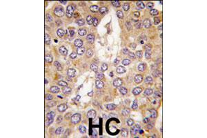 Formalin-fixed and paraffin-embedded human hepatocellular carcinoma reacted with CSNK1G2 polyclonal antibody  , which was peroxidase-conjugated to the secondary antibody, followed by DAB staining. (Casein Kinase 1 gamma 2 Antikörper  (C-Term))