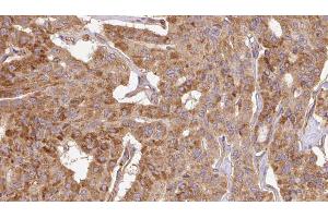 ABIN6267112 at 1/100 staining Human thyroid cancer tissue by IHC-P.