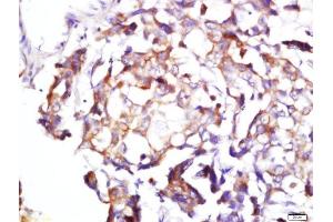 Formalin-fixed and paraffin embedded human lung cancer labeled with Rabbit Anti-BDKRB1 Polyclonal Antibody, Unconjugated  at 1:200 followed by conjugation to the secondary antibody and DAB staining (BDKRB1 Antikörper  (AA 161-260))