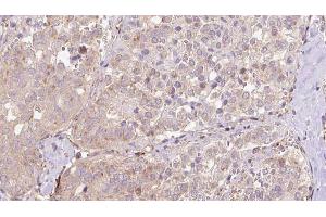 ABIN6273319 at 1/100 staining Human thyroid cancer tissue by IHC-P. (SLC13A2 Antikörper)