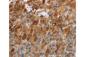 Immunohistochemistry of Human thyroid cancer using CCR9 Polyclonal Antibody at dilution of 1:40 (CCR9 Antikörper)