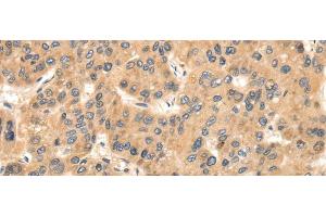 Immunohistochemistry of paraffin-embedded Human liver cancer using TTC23 Polyclonal Antibody at dilution of 1/35 (TTC23 Antikörper)