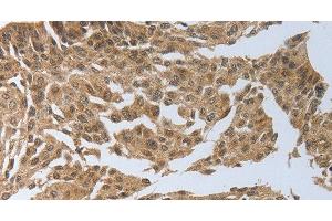 Immunohistochemistry of paraffin-embedded Human cervical cancer using PSMD6 Polyclonal Antibody at dilution of 1:40 (PSMD6 Antikörper)