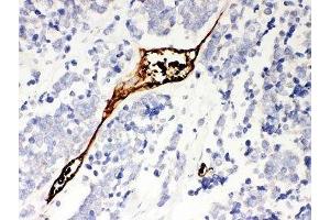 IHC-P: Mesothelin antibody testing of human lung cancer tissue (Mesothelin Antikörper  (AA 306-576))