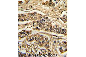 Formalin-fixed and paraffin-embedded human breast carcinomareacted with FREQ polyclonal antibody , which was peroxidase-conjugated to the secondary antibody, followed by AEC staining. (NCS1 Antikörper  (Internal Region))