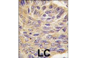 Formalin-fixed and paraffin-embedded human lung carcinoma tissue reacted with MEG2 antibody , which was peroxidase-conjugated to the secondary antibody, followed by DAB staining.