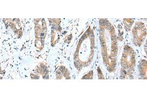 Immunohistochemistry of paraffin-embedded Human gastric cancer tissue using ACBD4 Polyclonal Antibody at dilution of 1:30(x200) (ACBD4 Antikörper)
