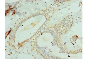 Immunohistochemistry of paraffin-embedded human breast cancer using ABIN7148180 at dilution of 1:100 (CCDC97 Antikörper  (AA 1-343))