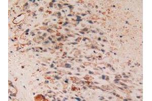 IHC-P analysis of Human Lung Cancer Tissue, with DAB staining. (Cytokeratin 7 Antikörper  (AA 91-394))