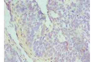 Immunohistochemistry of paraffin-embedded human endometrial cancer using ABIN7172842 at dilution of 1:100 (TGFBI Antikörper  (AA 30-250))