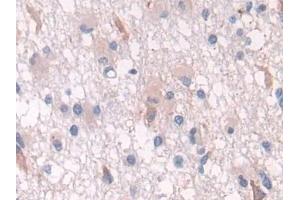 Detection of PSMD2 in Human Glioma Tissue using Polyclonal Antibody to Proteasome 26S Subunit, Non ATPase 2 (PSMD2)