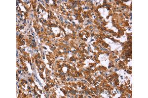 Immunohistochemistry of Human gastric cancer using HACE1 Polyclonal Antibody at dilution of 1:40 (HACE1 Antikörper)