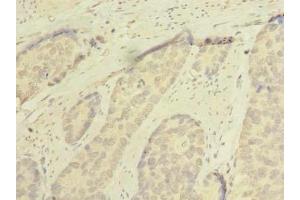 Immunohistochemistry of paraffin-embedded human gastric cancer using ABIN7168953 at dilution of 1:100