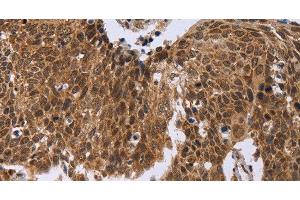 Immunohistochemistry of paraffin-embedded Human cervical cancer tissue using ERCC6L Polyclonal Antibody at dilution 1:30 (ERCC6L Antikörper)