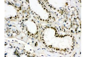 Anti- EWSR1 Picoband antibody, IHC(P) IHC(P): Human Mammary Cancer Tissue (EWSR1 Antikörper  (Middle Region))