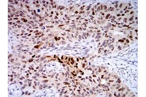 Immunohistochemical analysis of paraffin-embedded cervical cancer tissues using TTF1 mouse mAb with DAB staining. (TTF1 Antikörper  (AA 1-150))