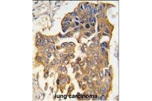 Formalin-fixed and paraffin-embedded human lung carcinoma tissue reacted with CASP9 antibody (Center) (ABIN392509 and ABIN2842072) , which was peroxidase-conjugated to the secondary antibody, followed by DAB staining. (Caspase 9 Antikörper  (AA 183-211))