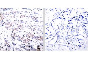 Immunohistochemical analysis of paraffin- embedded breast carcinoma. (ELK1 Antikörper  (Ser383))