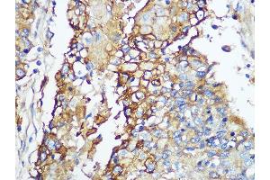 Immunohistochemistry of paraffin-embedded human esophageal using Carbonic Anhydrase 9 (C/G250) Rabbit mAb (ABIN1680827, ABIN3019284, ABIN3019285 and ABIN7101745) at dilution of 1:100 (40x lens). (CA9 Antikörper)