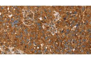 Immunohistochemistry of paraffin-embedded Human breast cancer tissue using TBC1D1 Polyclonal Antibody at dilution 1:45 (TBC1D1 Antikörper)