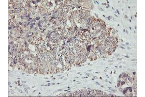 Immunohistochemical staining of paraffin-embedded Adenocarcinoma of Human ovary tissue using anti-AGPAT5 mouse monoclonal antibody.