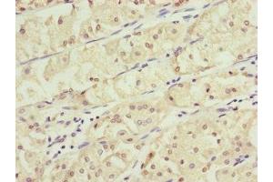 Immunohistochemistry of paraffin-embedded human gastric cancer using ABIN7157235 at dilution of 1:100 (KANSL3 Antikörper  (AA 1-200))