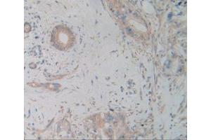 IHC-P analysis of Human Cholangiocarcinoma Tissue, with DAB staining. (alpha Actinin 4 Antikörper  (AA 1-269))