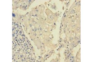 Immunohistochemistry of paraffin-embedded human lung cancer using ABIN7172870 at dilution of 1:100 (TRPM8 Antikörper  (AA 1-192))