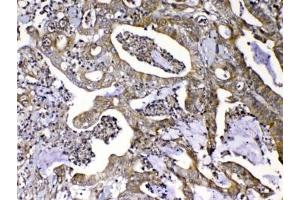 IHC testing of FFPE human colon cancer tissue with MMP16 antibody at 1ug/ml. (MMP16 Antikörper)