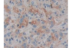 Detection of IL2 in Human Prostate cancer Tissue using Monoclonal Antibody to Interleukin 2 (IL2) (IL-2 Antikörper  (AA 21-153))