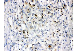 Anti- Lipocalin 2 Picoband antibody, IHC(P) IHC(P): Human Intestinal Cancer Tissue (Lipocalin 2 Antikörper  (AA 21-198))