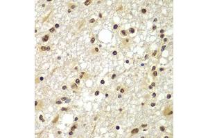 Immunohistochemistry of paraffin-embedded human brain cancer using ZNF20 antibody  at dilution of 1:100 (40x lens). (ZNF20 Antikörper  (AA 1-200))