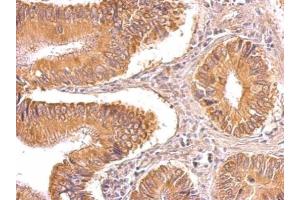 IHC-P Image TIP30 antibody detects TIP30 protein on human gastric cancer by immunohistochemical analysis. (HIV-1 Tat Interactive Protein 2, 30kDa (HTATIP2) Antikörper)