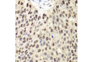 Immunohistochemistry of paraffin-embedded human lung cancer using MCM6 antibody (ABIN5971012) at dilution of 1/100 (40x lens). (MCM6 Antikörper)