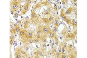 Immunohistochemistry of paraffin-embedded Human liver damage using EIF4G1 Polyclonal Antibody at dilution of 1:100 (40x lens). (EIF4G1 Antikörper)