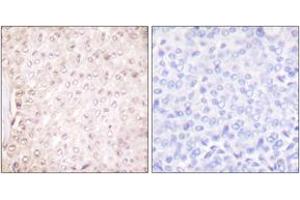 Immunohistochemistry analysis of paraffin-embedded human breast carcinoma tissue, using Stefin B Antibody. (CSTB Antikörper  (AA 49-98))