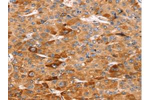 The image on the left is immunohistochemistry of paraffin-embedded Human liver cancer tissue using ABIN7192504(SLC5A11 Antibody) at dilution 1/25, on the right is treated with synthetic peptide. (Solute Carrier Family 5 (Sodium/inositol Cotransporter), Member 11 (SLC5A11) Antikörper)