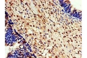 Immunohistochemistry of paraffin-embedded human ovarian cancer using ABIN7152101 at dilution of 1:100 (EEF2K Antikörper  (AA 201-500))