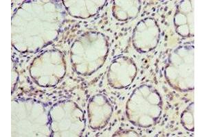 Immunohistochemistry of paraffin-embedded human colon cancer using ABIN7169893 at dilution of 1:100 (SUMO4 Antikörper  (AA 1-95))