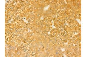 ABIN6262436 and ABIN6279508 at 1/100 staining human hepatocellular carcinoma by IHC-P. (ICAM5 Antikörper  (C-Term))