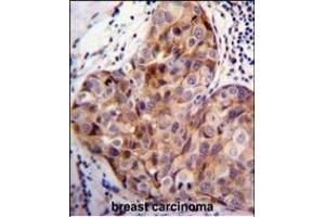 SCUBE2 Antibody (Center ) (ABIN655409 and ABIN2844955) immunohistochemistry analysis in formalin fixed and paraffin embedded human breast carcinoma followed by peroxidase conjugation of the secondary antibody and DAB staining. (SCUBE2 Antikörper  (AA 251-280))