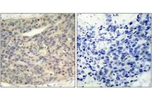 Immunohistochemistry analysis of paraffin-embedded human breast carcinoma, using LIMK1 (Phospho-Thr508) Antibody. (LIM Domain Kinase 1 Antikörper  (pThr508))