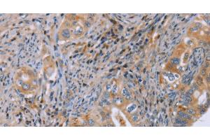 Immunohistochemistry of paraffin-embedded Human cervical cancer using GMFG Polyclonal Antibody at dilution of 1:50 (GMFG Antikörper)