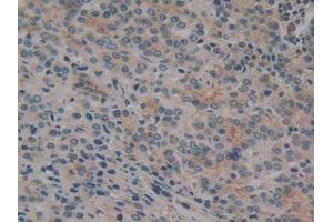 IHC-P analysis of Human Prostate Gland Cancer Tissue, with DAB staining. (CYLD Antikörper  (AA 170-338))