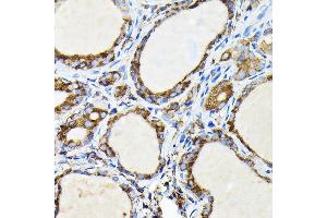 Immunohistochemistry of paraffin-embedded human thyroid cancer using FA Rabbit pAb (ABIN7267102) at dilution of 1:100 (40x lens). (FAM117A Antikörper)
