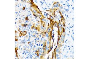 Immunohistochemistry of paraffin-embedded human lung squamous carcinoma tissue using Cytokeratin 13 (KRT13) (KRT13) Rabbit mAb (ABIN7268089) at dilution of 1:100 (40x lens). (Cytokeratin 13 Antikörper)